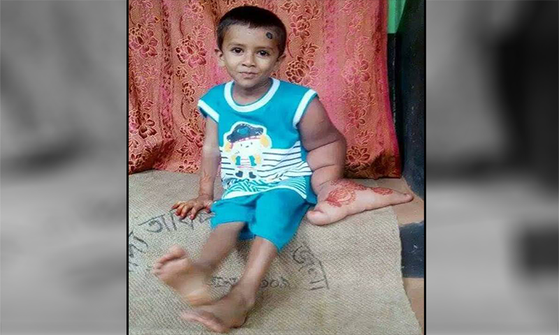 نایاب بیماری میں مبتلاپانچ سالہ بنگلادیشی بچہ