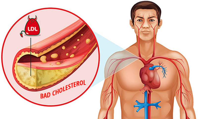 آج کا ٹوٹکا : پِتّے کی پتھری اور کولیسٹرول کے خاتمے کا آسان حل