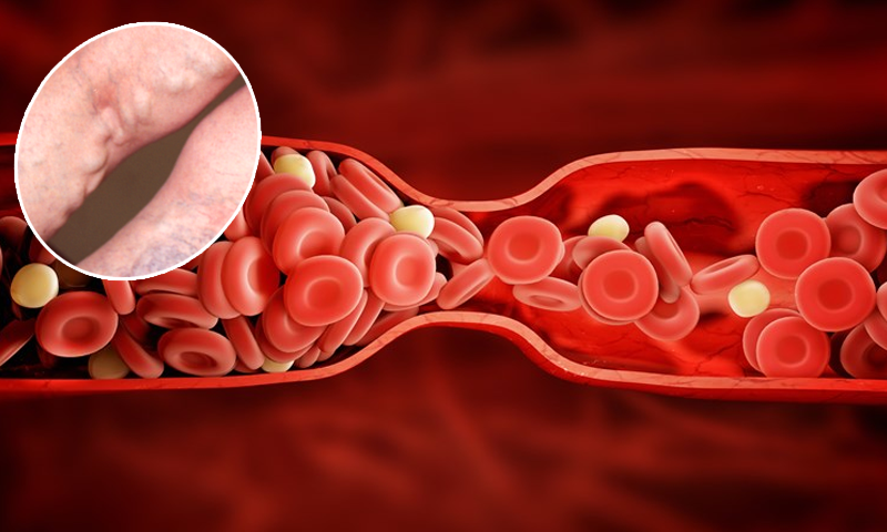 رگوں میں خون کی گٹھلی (بلڈ کلاٹ) کا علاج