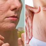 جلد سے ہر قسم کے نشانات ختم کرنے کے 8 طریقے