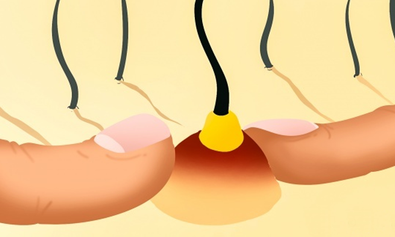 کیل مہاسوں کے بارے میں مشہور تصورات جو در اصل غلط ہیں